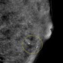 (주)씨디플러스 | 유방 미세석회화 c4a 기록(2) 6개월 후 f/u+ 조직검사 예약