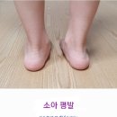 👣 소아 평발은 발견 즉시 교정해야 한다 이미지