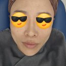 박성주조에피부과의원 | [연산역피부과 쥬베룩]부산 피부과의원 주베룩2회 후기 내돈내산 볼꺼짐 MTS 스킨부스터