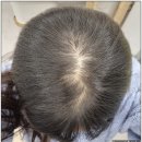 혜민웨이 | 강남탈모관리 사당동 탈모관리 혜민웨이 3주 솔직 후기