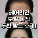 서울척척의원 | 압구정역모발이식 모우림의원 수술자국 헤어라인 교정