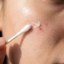 아름다운달과별약국 | 여드름 착색 연고 약국 효과, 색소침착 제거 기간 없애는법