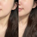 웨이브필 | 신사역피부과 리프팅이랑 쎄라필 받고 온 후기! 1회만에 효과 너무 만족 ✨ 전후비교〰️🌟