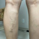 출산 후 하지정맥 수술후기 : 압구정 김도균외과