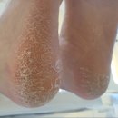 마젤네일 Mazel nail | 성남 서현동 발각질 시원하게 제거 성공 마젤네일
