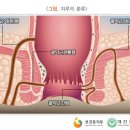 치루개 네이버블로그