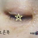한관종 아그네스 3차시술 후기 내돈내산