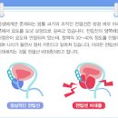 전립선 비대증 약 수술 방법, 좋은음식 (야간 빈뇨 절박뇨 잔뇨감) 이미지