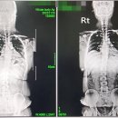 수강생이 보내온 치료후기 입니다(X-ray before - after) 이미지