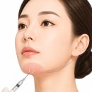 [피부] 보톡스 시술의 꿀팁 및 부작용 대처 방법