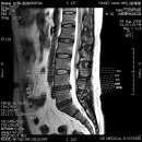 제 MRI 사진입니다. 4-5번 디스크라는데요..... 이미지