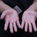 경보한의원 | 자꾸 재발하는 분당한포진, 피부과 대신 한의원을 찾는다면 어디가 잘하는 곳일까요