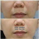 닥터준의원 | 팔자주름 리프팅 필러 쥬베룩 레디어스 나한테 효과좋고 부작용 적은 시술은 뭘까? 인천 피부과 원장 일기