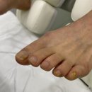 바미네일레푸스용인 | [충주내성발톱] 발톱무좀 고민 끝! ‘바미네일 레푸스 충주연수점’ 맞춤형 충주발관리 후기