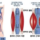 하지정맥류 下肢靜脈瘤 / Varicose Vein 이미지