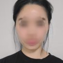 당신만의가치벨유의원 | 명동피부과 온다리프팅 6만줄 원장님개인상담 후 변화 후기