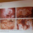 자궁경부비정형세포[자궁경부 비정형 편평상피세포, Atypical squamous cells] 이미지