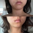 여우리 | 30분으로 붓기제거 리프팅팩 여우리 붓기패치 후기 전후 실화?