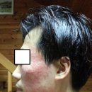 [피부] 소양인 안면에 붉은 발진? 여드름 증상 입니다. 이미지