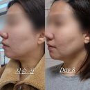 진주피부과 인모드 시술 후기 ✨ 투턱 파괴, 통증, 부작용 정보