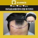 머리나라 | 머리심는비용 환자 리얼 후기까지