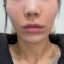 또팔자 | 청담동 쥬베룩 볼륨 3차팔자주름 개선 후기