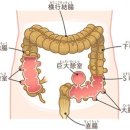 술은 끊어야 돼？ 대장내시경검사에서 「게실(憩室)」을 발견！ 이미지