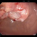 [상부위장관] MALT Lymphoma in the stomach 이미지