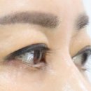 프로젝트 멍 | [내돈내산] 엄마의 회춘 프로젝트! 성형외과 상안검 수술 솔직 후기 (별점: ⭐⭐⭐⭐☆)