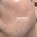 케어셀라 - 부산진구 | 셀라듀여드름크림 셀라듀 락토 바이옴 스팟크림 사용 후기 데일리 스팟 케어로 관리하기