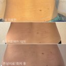 하얀 | 미라젯 튼살 레이저 후기 하얀튼살 전쟁을 선포한다 1회차