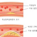 동맥경화 증상 및 검사 치료 (수술, 약) 이미지