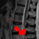 허리 디스크 mri 사진입니다 이미지