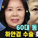 첫번째 중년성형은 바로 하안검수술! 중간 회복 단계 공개합니다💕 이미지