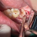 시너지치과의원 | [아산 연세원치과]사랑니 발치 후 통증, '약 복용 타이밍'만 알아도 절반은 성공입니다