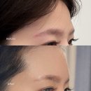 디테일의원 | 강남 이마필러 3주차 내돈내산 후기｜서울비비의원 솔직 경과