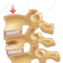 ■ 척추 압박 골절(spinal compression fracture) 원인 치료 이미지