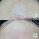 유황으로 이마 좁쌀여드름 없앤 후기