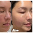 동래준피부과의원 | 부산 리쥬란 2cc 후기 | 동래 피부과 시술 정보 총정리 (엠보 기간, 시술주기, 홈케어)