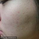 주식회사명현 | 편평사마귀 레이저 없이 좋아진 후기 모음 (연령별 얼굴 모집)