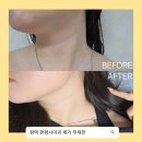안성한의원 | 평택편평사마귀제거 평택쥐젖제거 안성편평사마귀제거 안성쥐젖제거 직접 받아본 후기