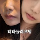 [강남피부과전문의 잘하는곳] 리쥬란힐러 써마지비용 고민대신 티타늄리프팅추천 (통증, 후기)