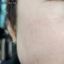 리젠의원 | 밴스의원 피부과 재생크림 발라봤어요 (EGF 리젠셀크림)