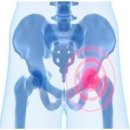 [고관절 통증] 고관절 전치환술 (Total Hip Replacement) 이미지