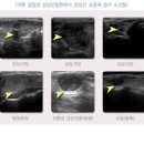 갑상선 혹 결절 크기 원인 물혹 낭종 위치 모양 초음파 검사 발견했다면 관리는 이미지