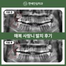 &#34;사랑니 대학병원 가야 하나요?&#34; 수원 사랑니 발치 치과에서 당일 매복 사랑니 발치 후기