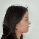 대구 365mc 이중턱, 팔 람스 2회차 후기 / 시술 1일차 2일차 붓기 멍 / 람스 시술 과정 및 꿀팁