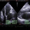 post PFO 이미지
