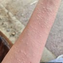 남일한의원 | 임신소양증 증상, 셋째 때 처음 겪었습니다. 잠도 못 잤던 가려움, 이렇게 잡았어요