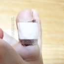 허준건강원 | 발가락 티눈 제거,티눈 민간요법 대추로 없애는법! 피부과 안가고 안아프게:)